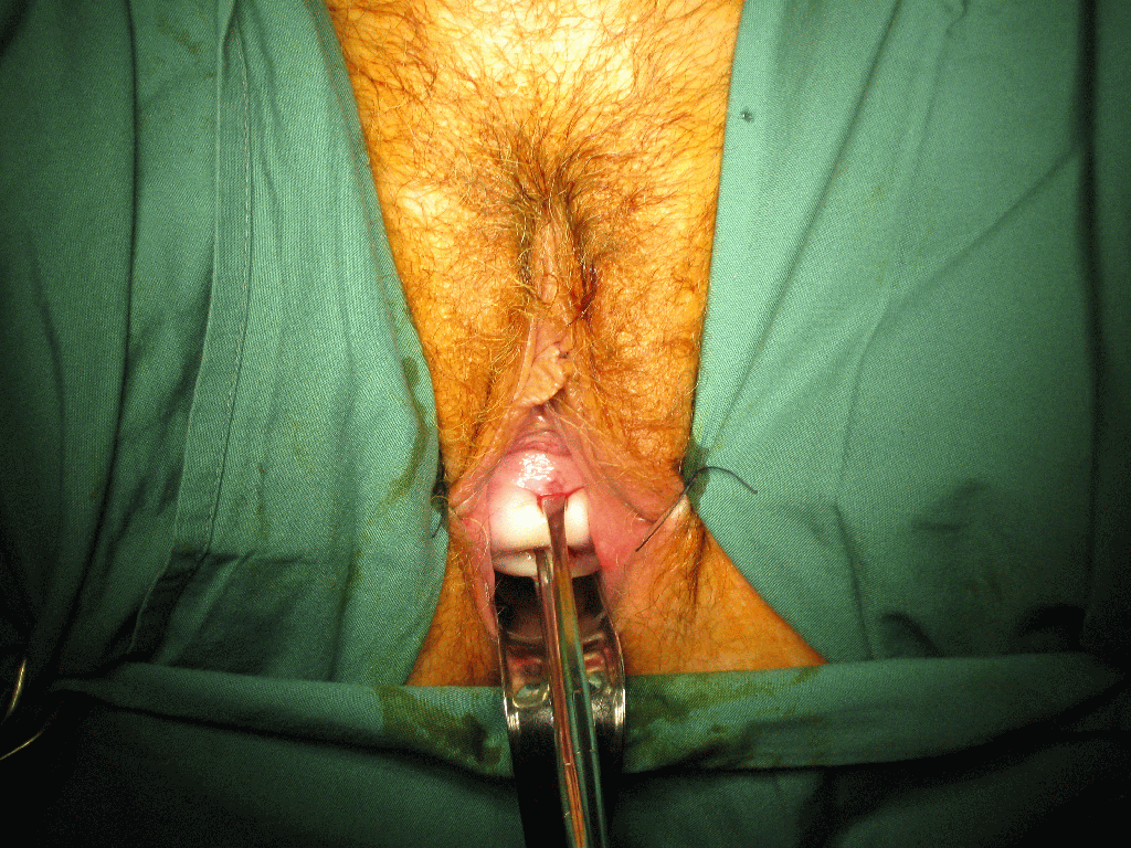 vaginal hysterectomy serag youssif1
